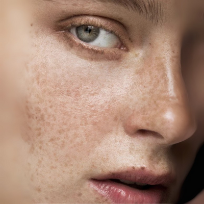Acne